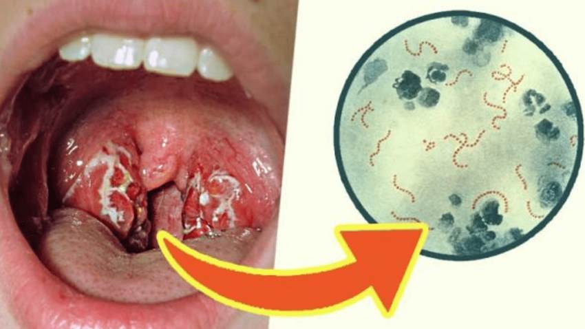 Factores predictivos son clave para la fiebre reumática en pacientes con dolor de garganta