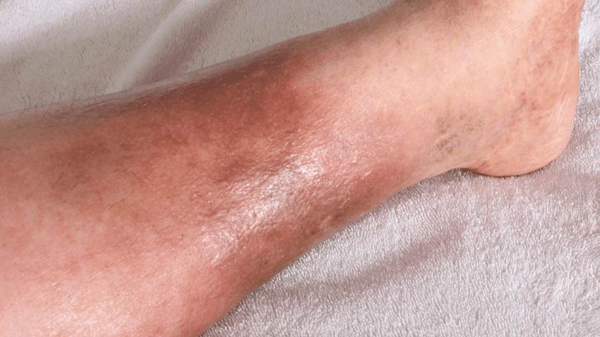 Trombosis venosa: Hinchazón o enrojecimiento de la pierna como síntoma