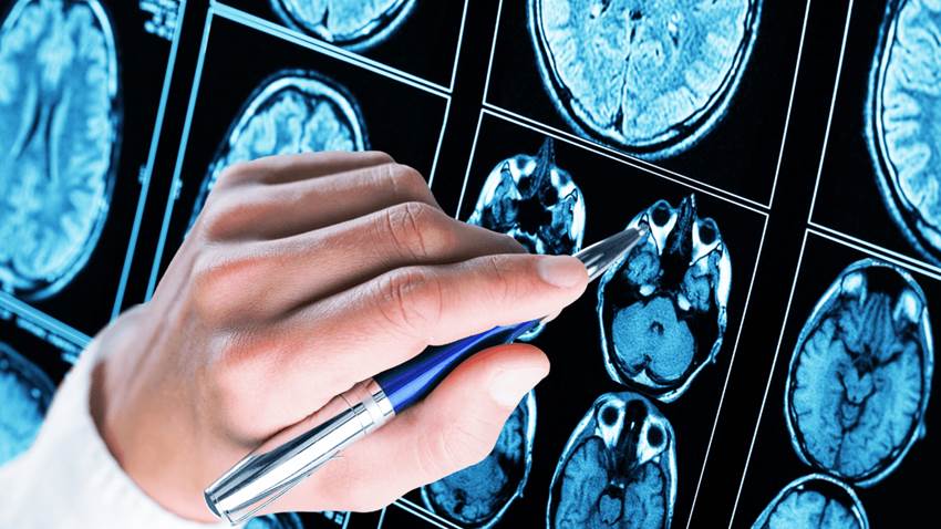 Investigación encuentra relación entre la epilepsia y riesgo de mortalidad en niños y jóvenes