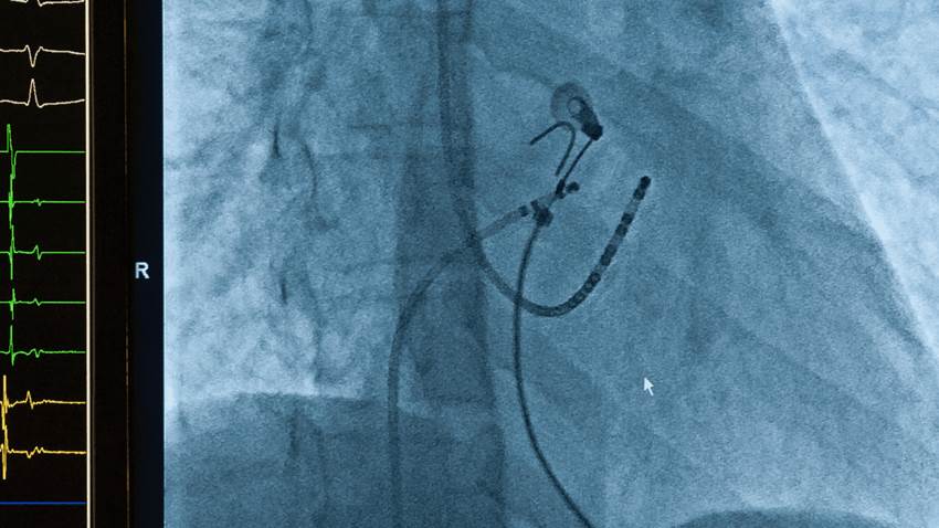 Procedimiento reduce la fibrilación auricular postoperatoria después de cirugía cardíaca, según estudio