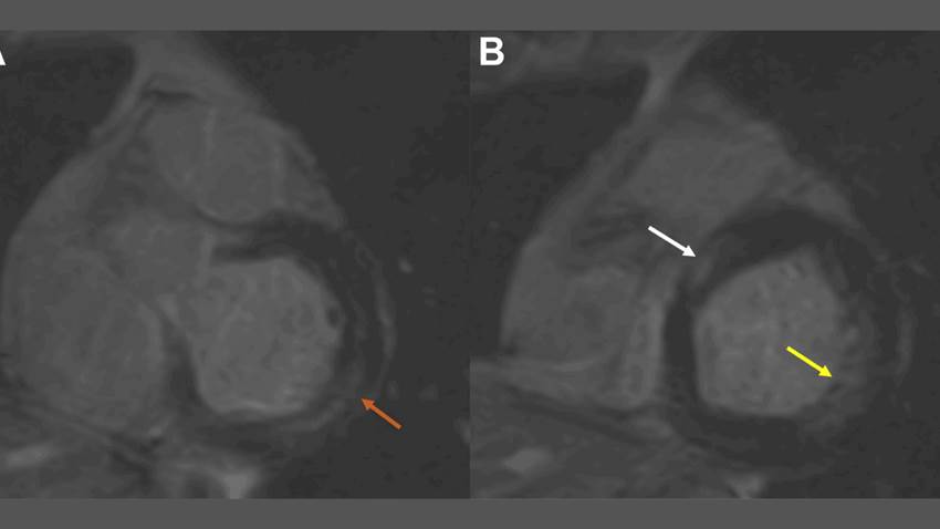 Síndrome de prolapso de válvula mitral puede conducir a infarto, según caso clínico
