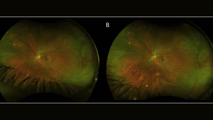 Reportan caso de coriorretinitis unilateral y ceguera parcial en paciente infectado por el virus Nilo