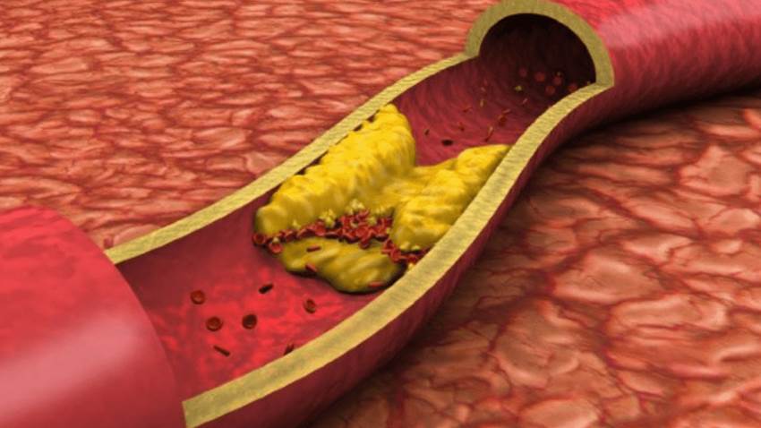 Calcio en las arterias coronarias y el riesgo de enfermedad cardiovascular aterosclerótica