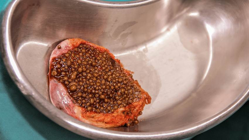 Hijos de madres fumadoras tienen mayor riesgo de desarrollar cálculos biliares, según estudio