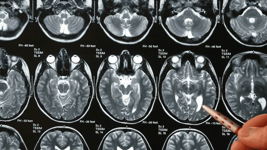 Síntomas depresivos por debajo del umbral se asocian con una mayor de deterioro cognitivo, según estudio