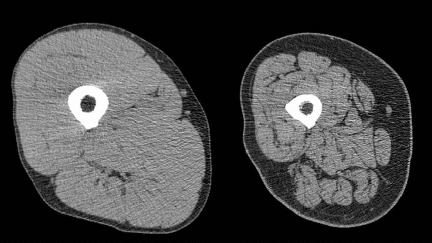La sarcopenia es un factor de mal pronóstico en pacientes que usaron quimiorradioterapia, según estudio