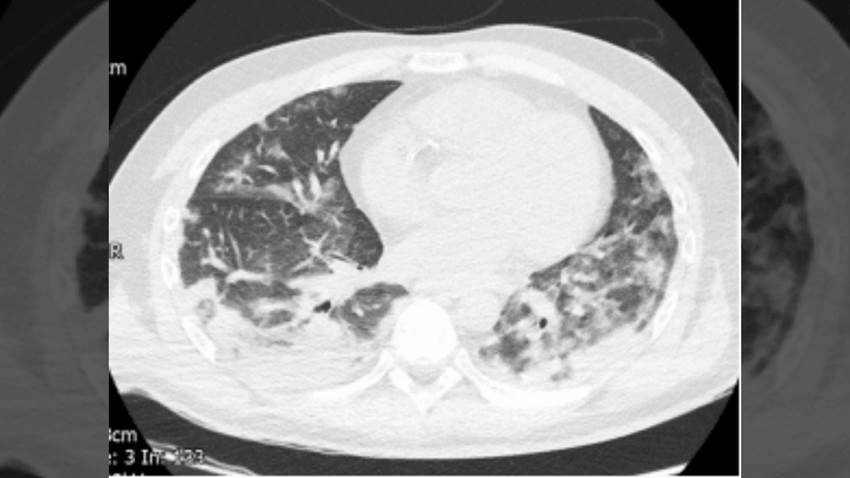 Registran accidente cerebrovascular fatal por enfermedad grave de COVID-19 en paciente joven