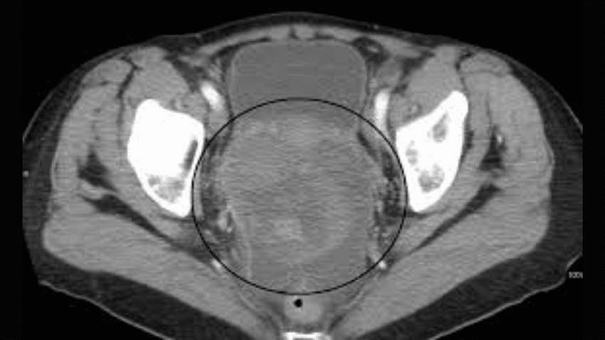 Pamiparib muestra una buena respuesta en pacientes con cáncer de ovario, de acuerdo a estudio en fase 2
