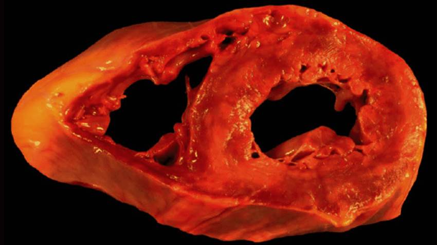 Un tiempo más prolongado entre las dosis de ARNm de COVID puede reducir el riesgo de miocarditis