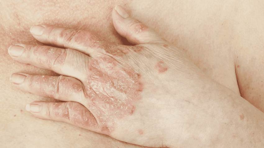 Revisión sistemática de literatura sostiene beneficio de biológicos para raro tipo de psoriasis