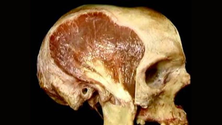 El grosor del músculo temporal predice la supervivencia del linfoma del Sistema Nervioso Central