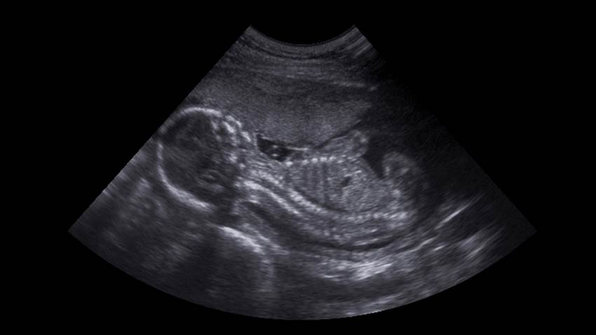 Virus por COVID-19 en el embarazo no daña la estructura del cerebro fetal, según estudio