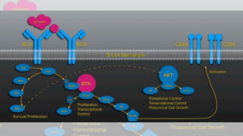Variante de Guillain-Barré se presenta en medio de una leucemia linfocítica y síndrome paraneoplásico
