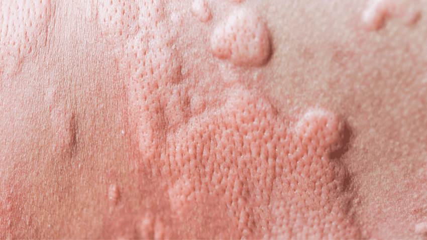 Estudio demuestra avance en los tratamientos en los pacientes con Angioedema en Puerto Rico