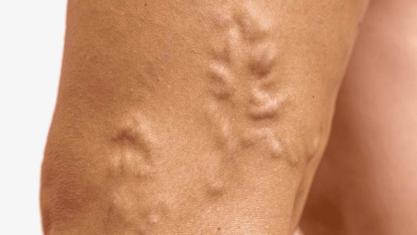 Síndrome de piernas inquietas estaría relacionado con accidentes cerebrovasculares, según estudio