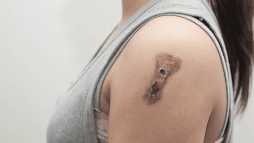 Una vacuna de ARN mensajero podría prevenir el cáncer de piel, según estudio