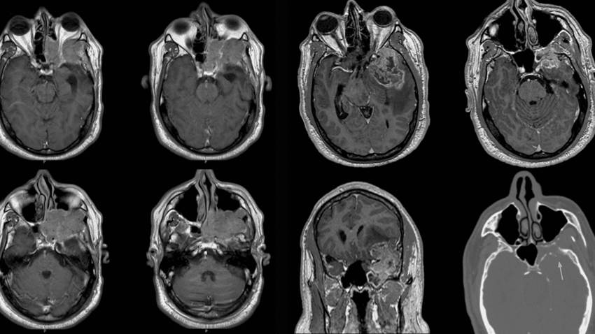 Inusual tumor de cerebro se registra en paciente puertorriqueño