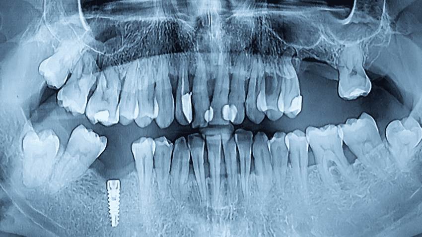Enfermedades sistémicas y periodontitis: así se relacionan