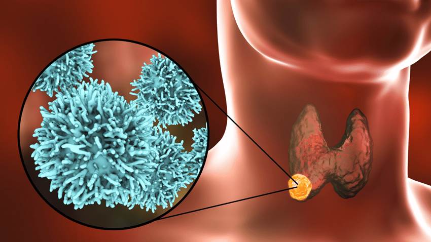 El cáncer de tiroides y su incidencia en Puerto Rico