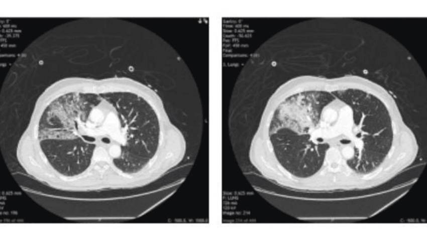 Se registra neumotórax espontáneo a tensión como complicación del COVID-19