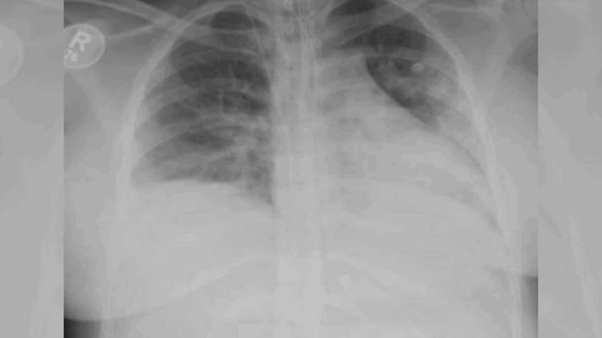 Medicamento no autorizado para mujeres gestantes le salva la vida a una embarazada con COVID19