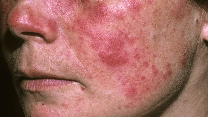 Estudio confirma relación entre la alteración del microbioma intestinal y el lupus eritematoso