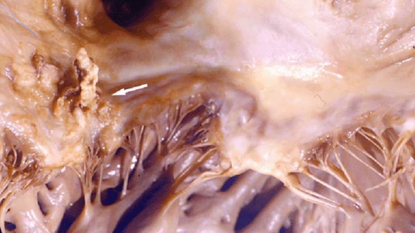 El tratamiento parental ambulatorio es seguro para la endocarditis infecciosa, según estudio