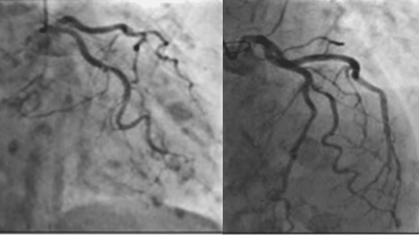 Miocardiopatía de Takotsubo amenazaría la vida adultos mayores que necesiten intervenciones quirúrgicas