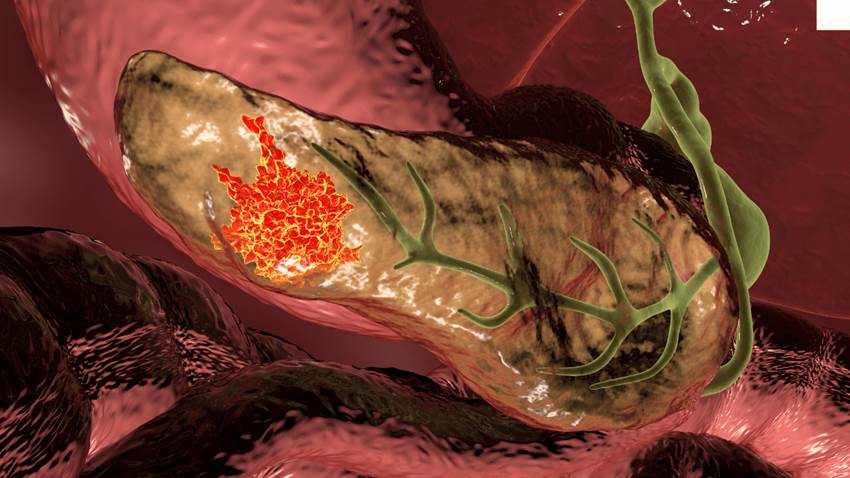 Estructuras de células inmunitarias podrían combatir el cáncer de páncreas