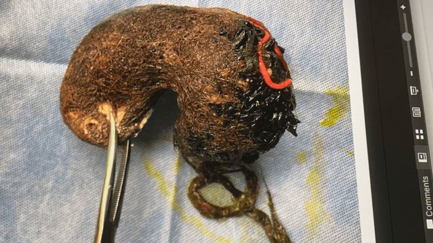 Síndrome de Rapunzel: Descubren masa de pelo en estómago de paciente pediátrica puertorriqueña
