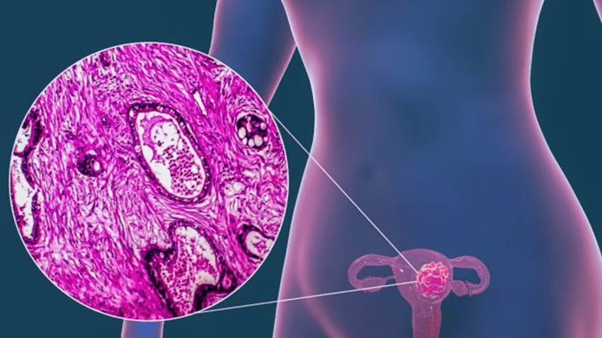 Así inicia el cáncer de ovario en las mujeres más propensas a padecerlo