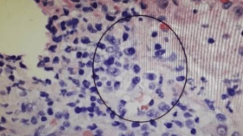 Hepatitis A desencadena una Hepatitis Autoinmune en paciente puertorriqueña