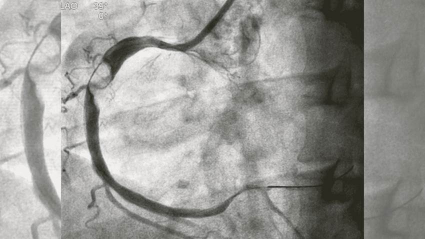 Dolor en el pecho, fatiga y otros síntomas del infarto de miocardio: conoce las causas y su tratamiento