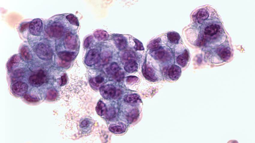 Incidencia del estrés crónico en respuesta a tratamiento T-Cell en pacientes con cáncer de ovario seroso