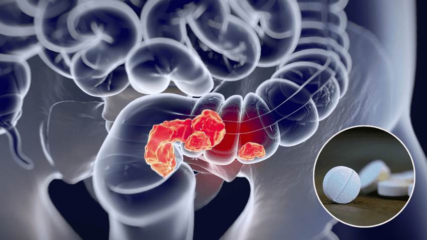 Estudio revela que la aspirina en dosis bajas reduce la incidencia del cáncer colorrectal
