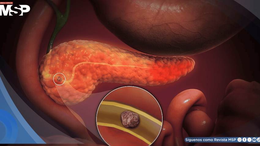 Pancreatitis aguda: Un episodio podría duplicar el riesgo de desarrollar diabetes