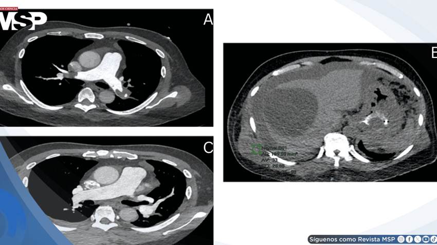 Embolia pulmonar en silla de montar asociada a fármaco en paciente con enfermedad renal y cáncer gástrico