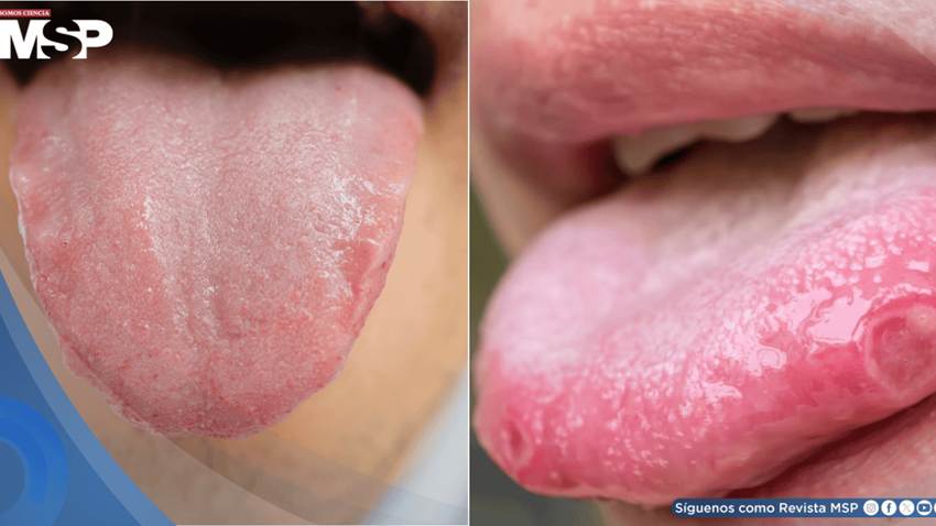 ¿Lengua pálida, lisa o con úlceras? Señales que pueden alertar sobre problemas de salud