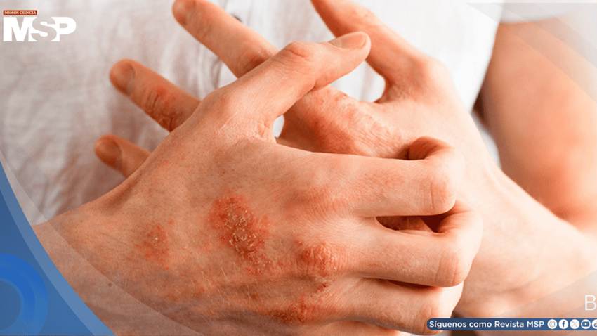 ¿Picazón persistente y piel seca? Esto es lo que dicen las nuevas guías de dermatitis atópica