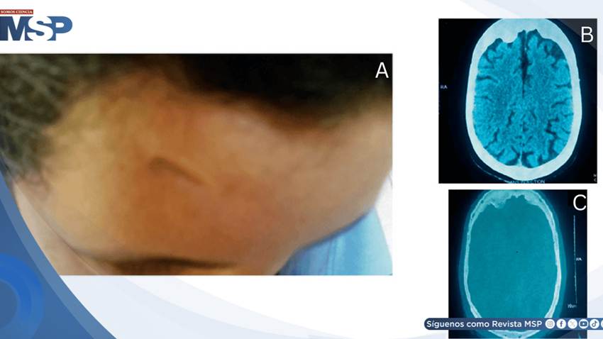 Traumatismo craneal en la infancia e hiperostosis frontal se manifiesta con psicosis severa en la adultez