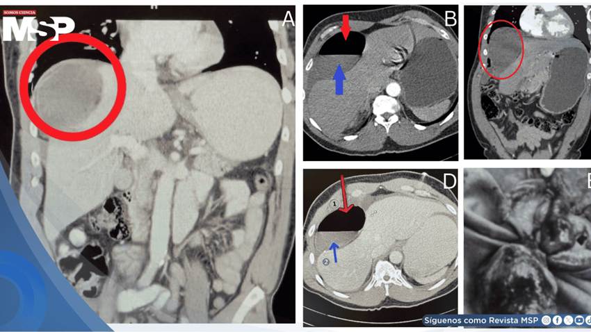 Dolor abdominal y vómitos revelan un divertículo gigante de Meckel con obstrucción e isquemia en adulto
