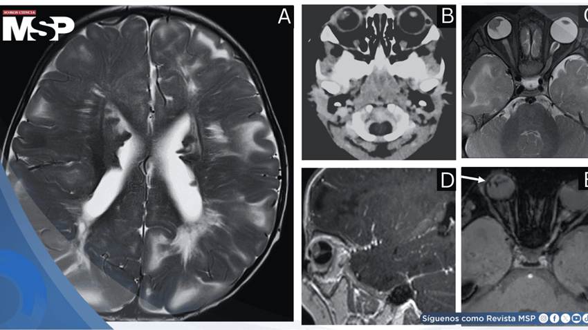 Pupila blanca en lactante revela esclerosis tuberosa y desprendimiento de retina