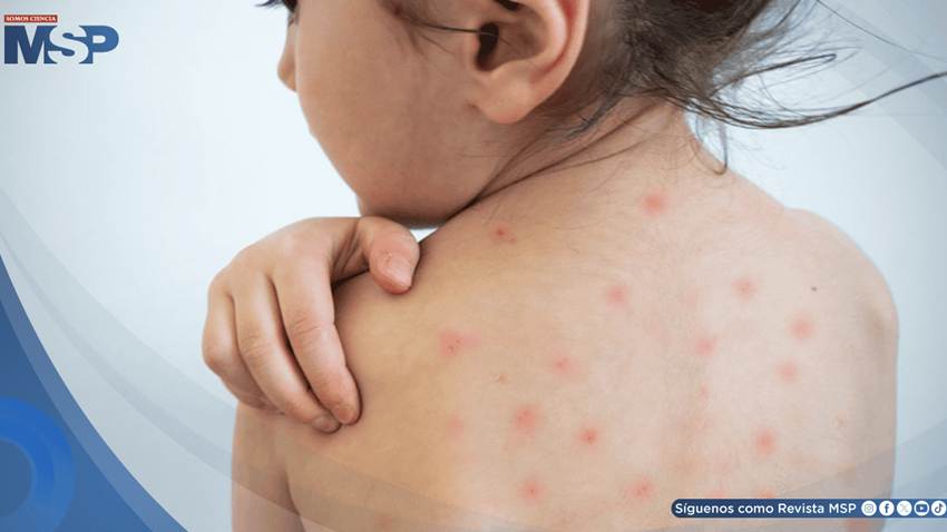 ¿Por qué el sarampión es altamente contagioso? Estas podrían ser sus complicaciones