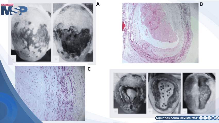 Necrosis extensa del cuero cabelludo como complicación de arteritis de células gigantes