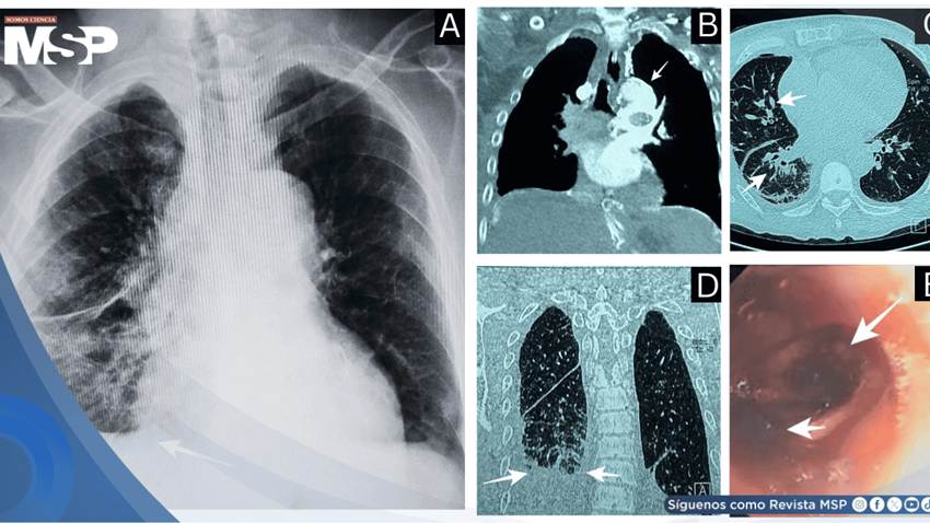 Hemorragia pulmonar por trombosis de vena cava simula sangrado digestivo en paciente en hemodiálisis