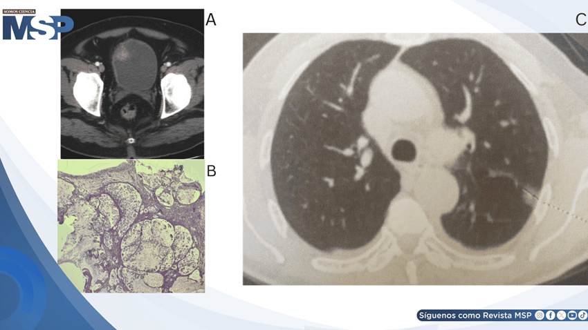Hematuria reveló adenocarcinoma mucinoso de células en anillo de vejiga con metástasis pulmonar y ósea