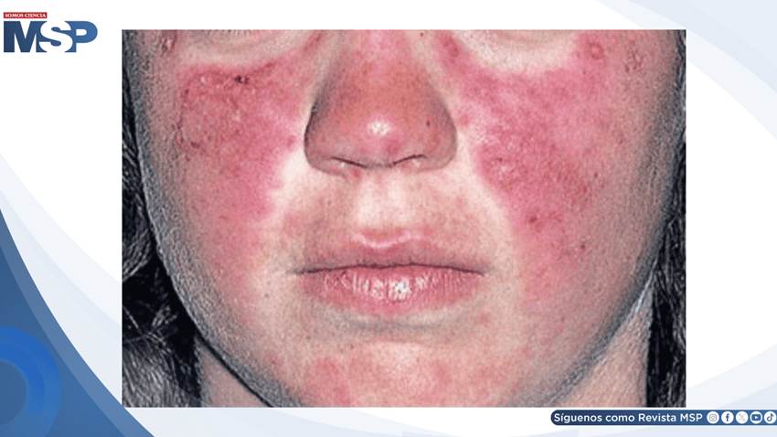 Erupción facial fotosensible, artritis y fatiga revelan un caso de lupus sistémico