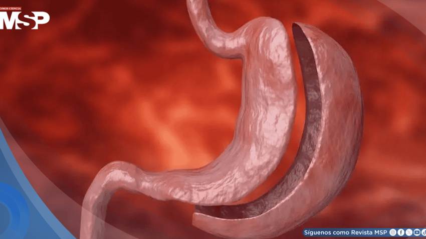 Cirugía bariátrica supera a fármacos GLP-1 en protección cardiovascular de pacientes con diabetes tipo 2