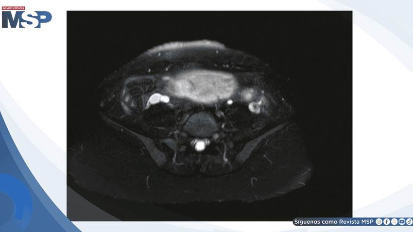 Apendicitis aguda enmascarada por hiperemesis gravídica:Dolor lumbar intratable en gestante de 14 semanas