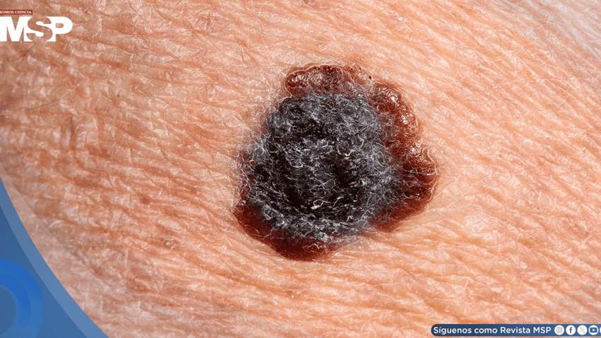 Asimetría, color irregular y bordes difusos: Cómo reconocer un lunar peligroso y el cáncer de piel